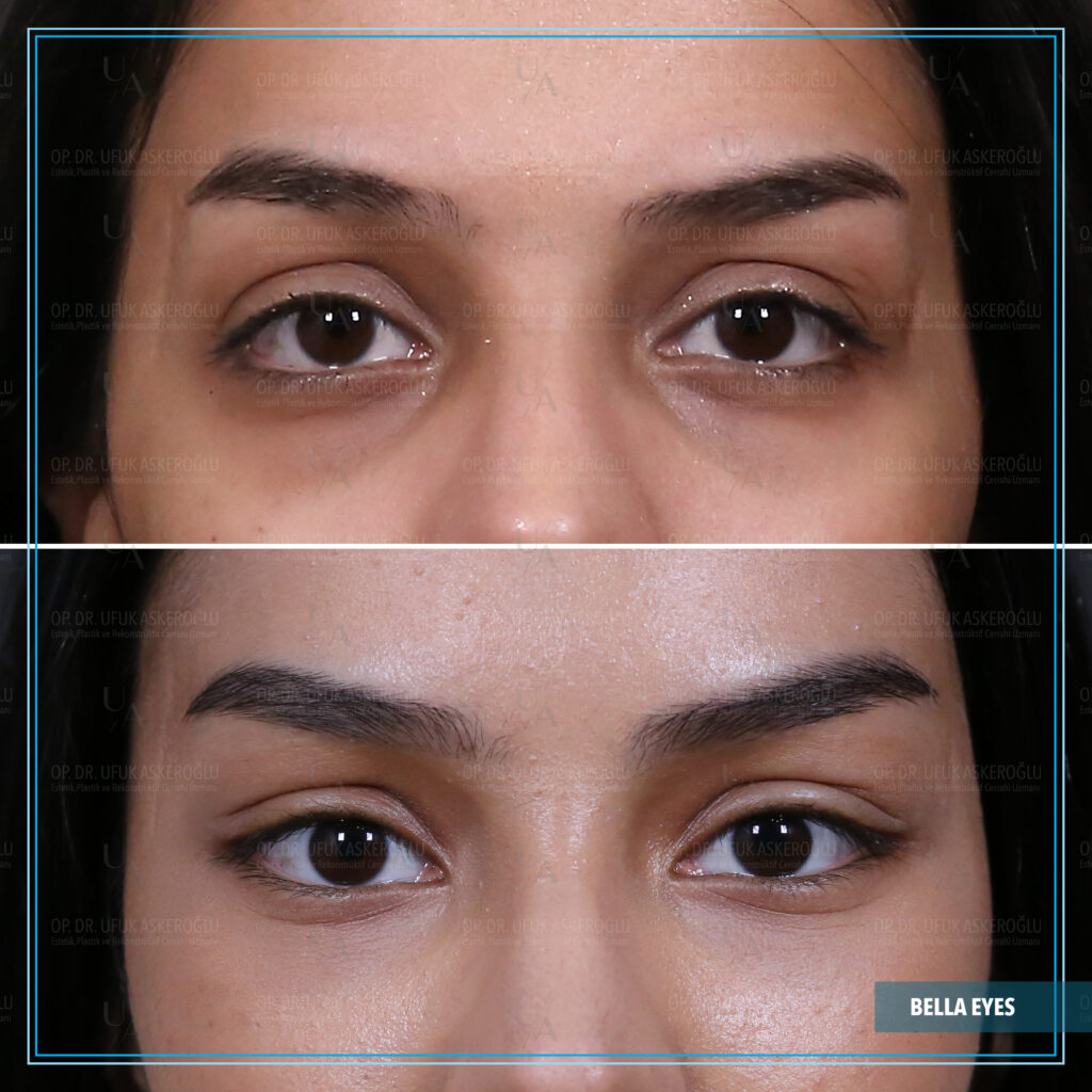 Bella Eyes Öncesi Sonrası