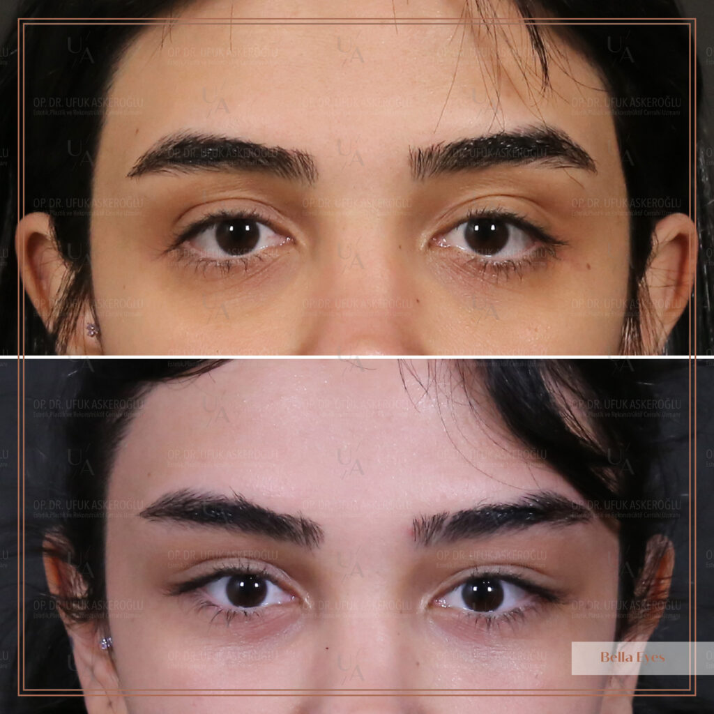 Bella Eyes kalıcı mı Bella Eyes kalıcı mı