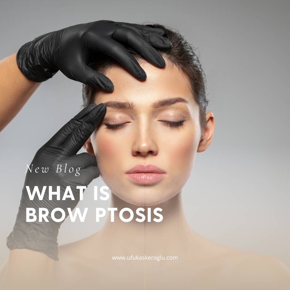 What Is Brow Ptosis